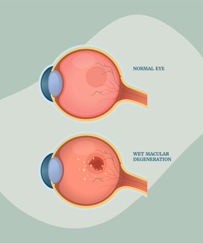 Living Well with Age-Related Macular Degeneration: Expert Advice for Improved Quality of Life