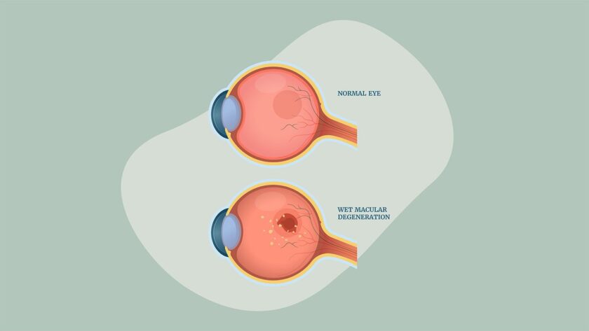 Living Well with Age-Related Macular Degeneration: Expert Advice for Improved Quality of Life